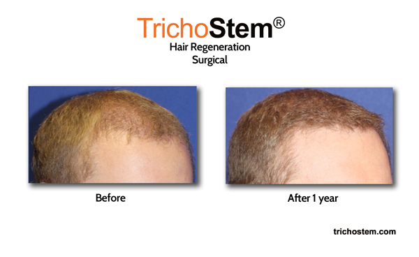 Visible hair regrowth 1 year after Trichostem Hair Regeneration treatment