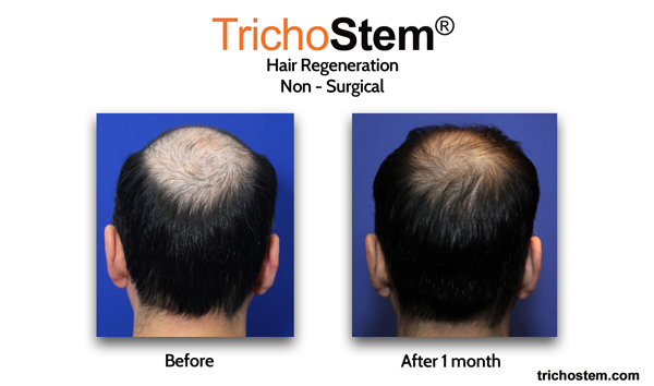 Visible results 1 month after Trichostem treatment