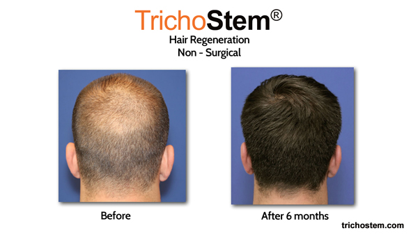 hair loss treatment before and after photo