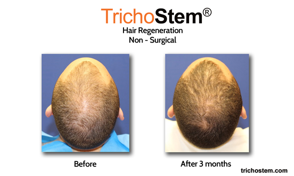 Trichostem Hair Regeneration results