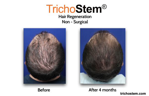 hair loss treated with TrichoStem hair regeneration