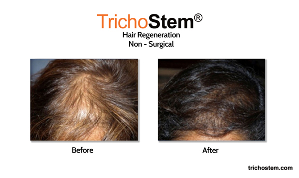 further hair loss prevented with Trichostem