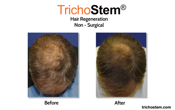 before and after Trichostem hair regeneration