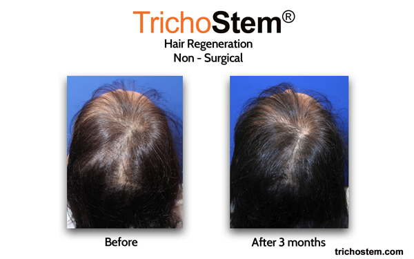 TrichoStem™ Hair Regeneration's results on women