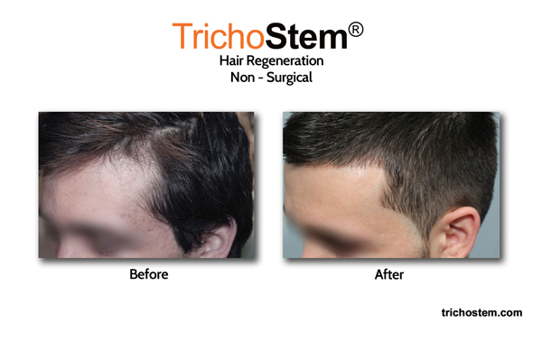 Trichostem Hair Regeneration treatment performed by Dr. Prasad