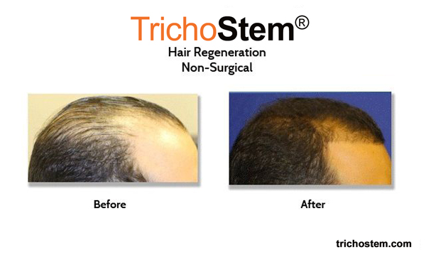 male receding hairline treated with trichostem hair regeneration