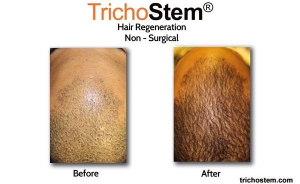 male patient before and after Trichostem hair regeneration