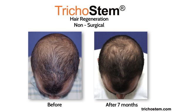 hair regrowth 7 months after Trichostem treatment