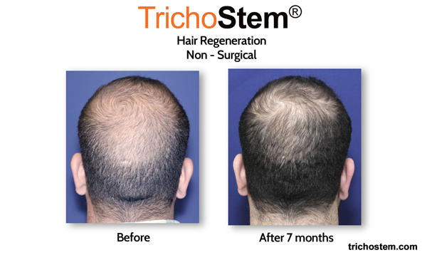 trichostem hair regeneration results after 7 months