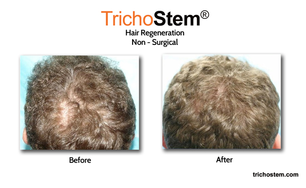 Trichostem hair regeneration results