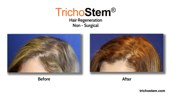 Trichostem hair regeneration result on women