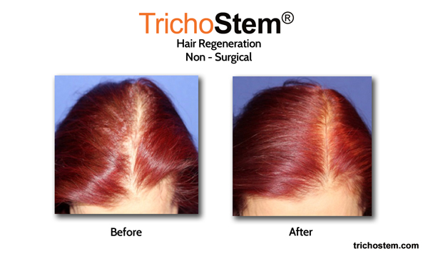 Trichostem hair regeneration results on women