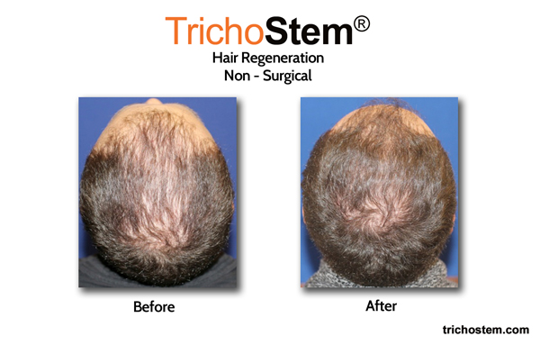 Before and after Trichostem treatment male patient