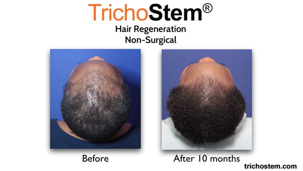 african-american female Before and After Trichostem™ Treatment
