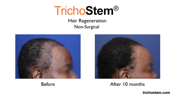 Trichostem treatment results on African-American female