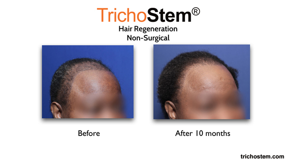 African-American female hair loss treated