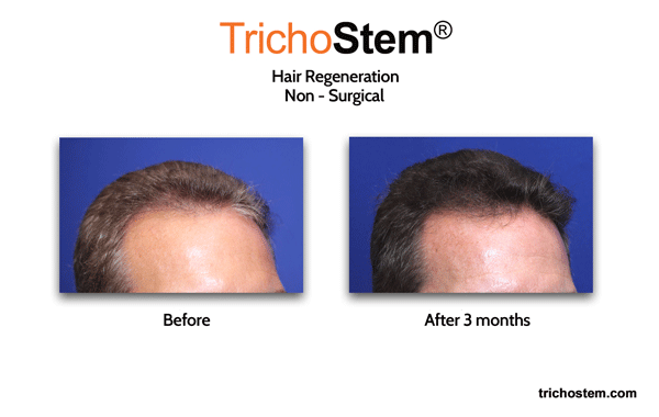 3 months after hair regeneration