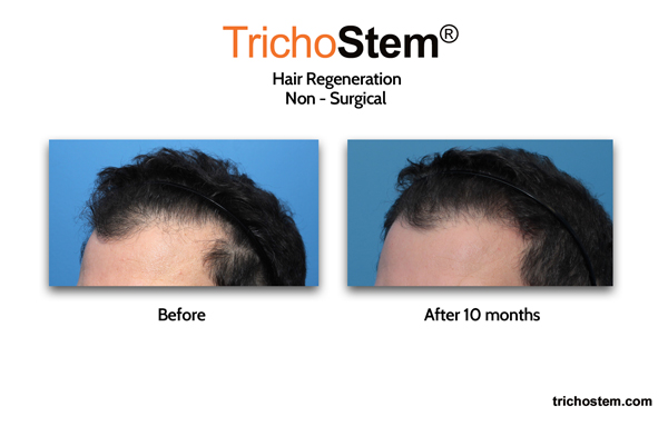 10 months after hair regeneration