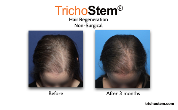 thicker hair 3 months after injection