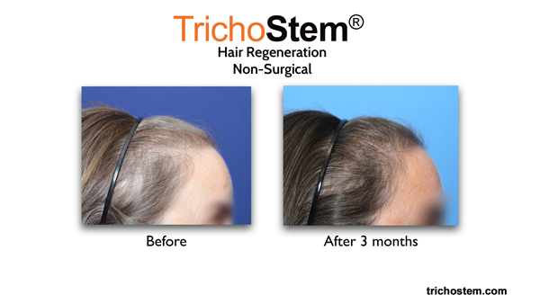 female pattern hair loss