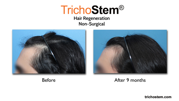 hair loss in frontal and temporal areas improved