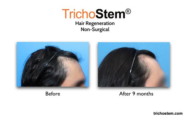 hair renegeration results on male pattern hairloss