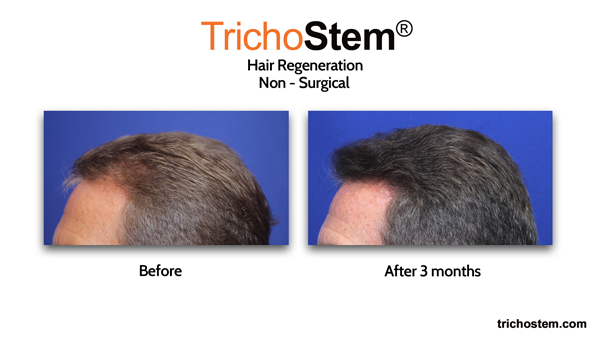 before and after trichostem hair regeneration