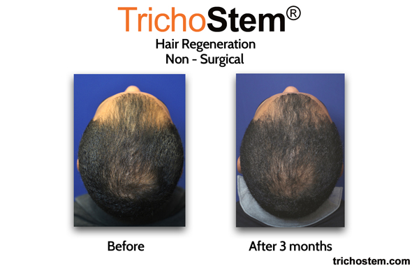 3 months after trichostem hair regeneration