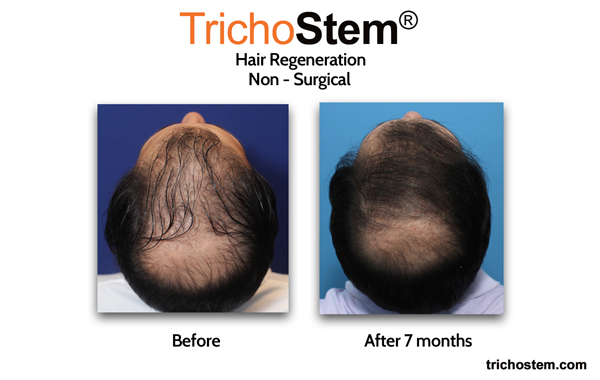 7 months after trichostem hair regeneration