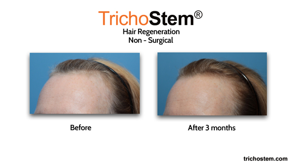 female hair loss before and after hair regeneration