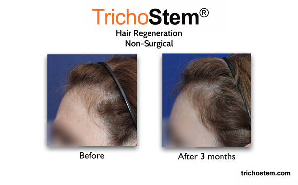 female pattern hair loss on temples improved with hair regeneration