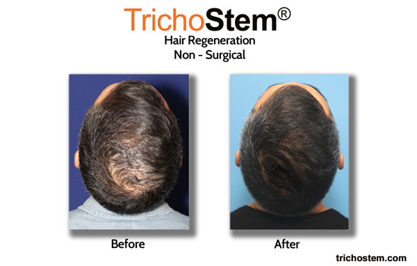 non-surgical hair regeneration before and after