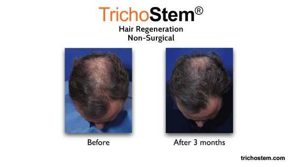 male pattern hairloss 3 months after hair regeneration