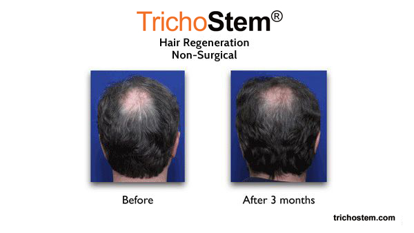 male pattern hair loss before and after hair regeneration results
