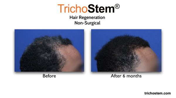 Before and after hair regeneration