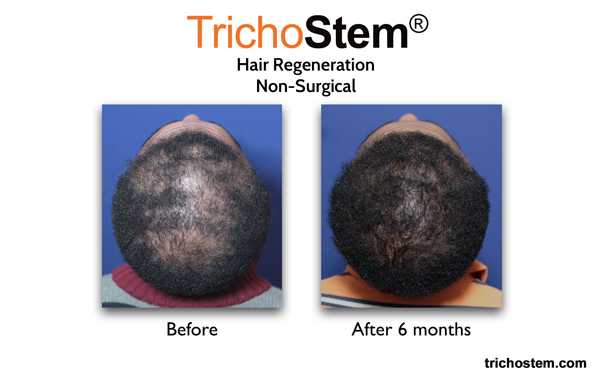 6 months after Trichostem hair regeneration
