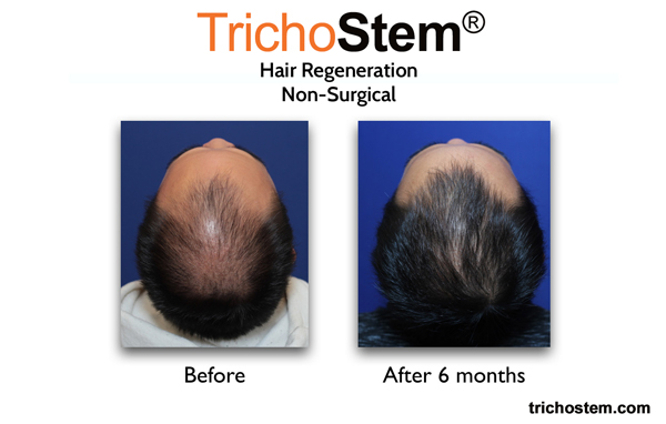 28 yrs old male after hair regeneration