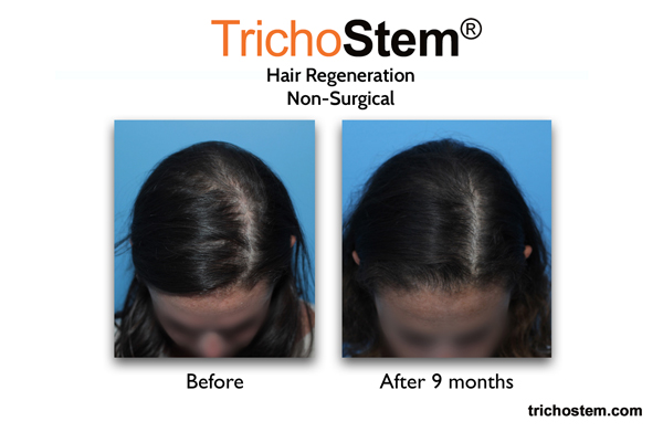 female hair loss after hair regeneration