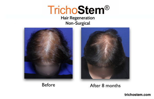 8 months after TrichoStem