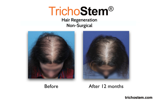 female pattern hair loss after 12 months