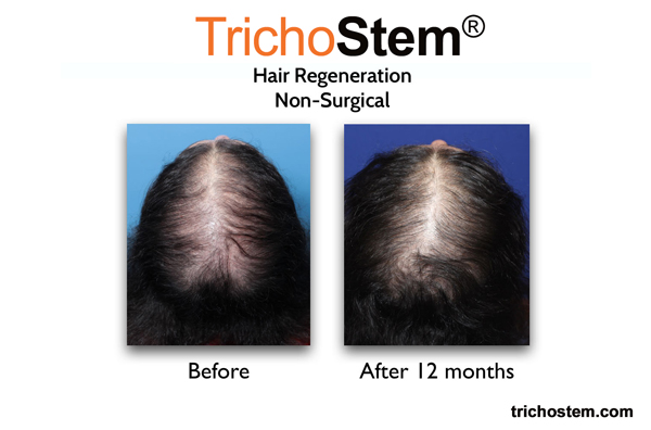 12 months after hair regeneration