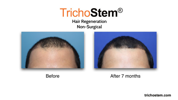 7 months after hair regeneration