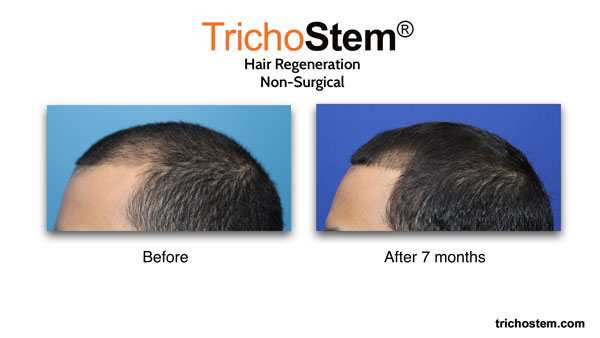 hair restoration left sideview