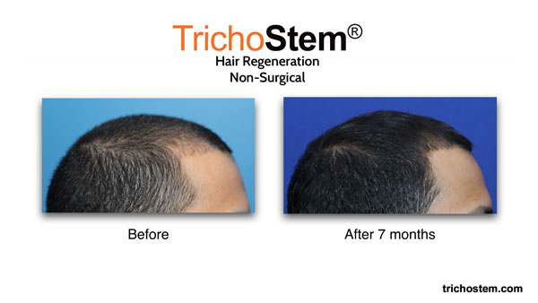 hair regeneration right side view