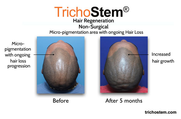 hair regrowth before and after photo