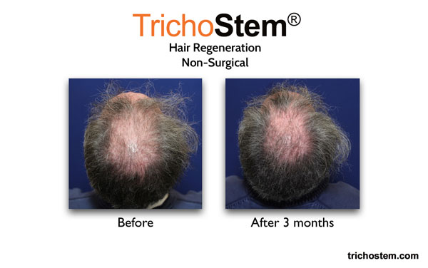 hair regeneration results 3 months after