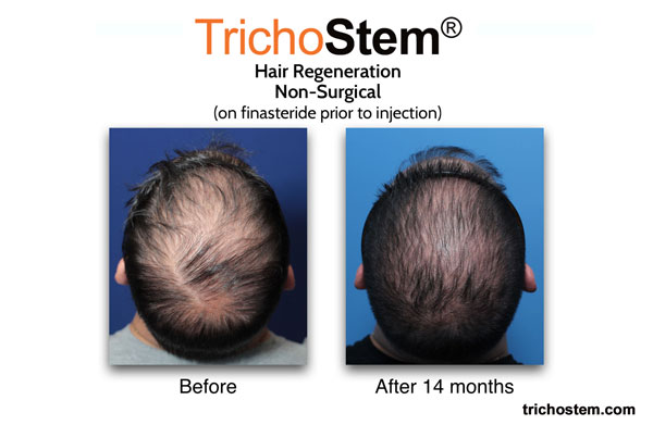 hair regeneration results on man with advance hair loss problem