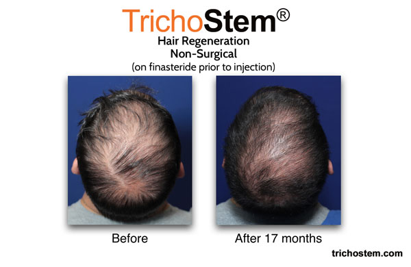 male pattern baldness effectively treated with the treatment