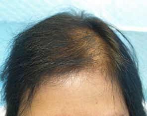3 months after ACell female hair loss treatment