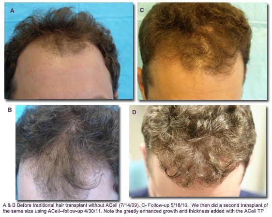 Traditional Transplant without Acell vs Hair Transplant with Acell results on male patients